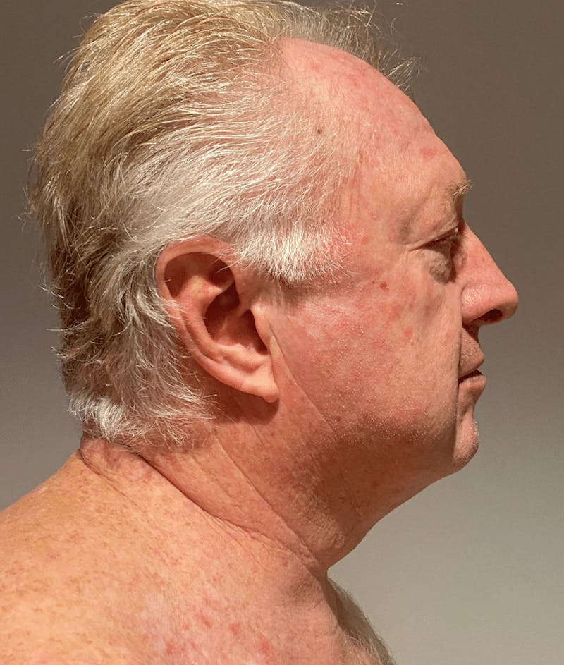 Neck Liposuction with Skin Tightening (Renuvion) Before & After Gallery - Patient 382987 - Image 8