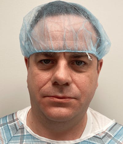 Neck Liposuction with Skin Tightening (Renuvion) Before & After Gallery - Patient 142622 - Image 1
