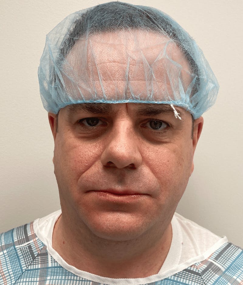 Neck Liposuction with Skin Tightening (Renuvion) Before & After Gallery - Patient 142622 - Image 1
