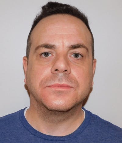 Neck Liposuction with Skin Tightening (Renuvion) Before & After Gallery - Patient 142622 - Image 2