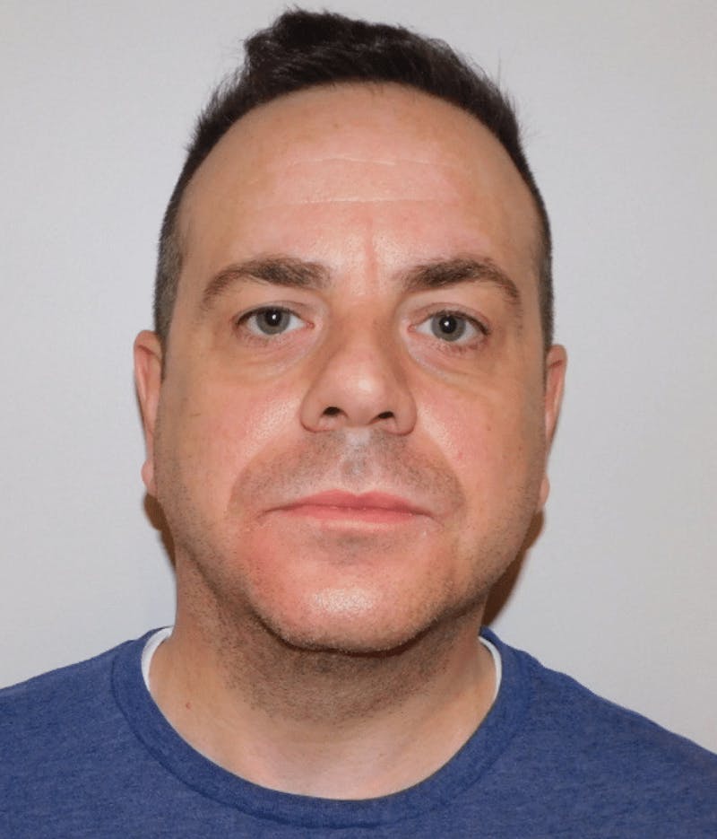 Neck Liposuction with Skin Tightening (Renuvion) Before & After Gallery - Patient 142622 - Image 2