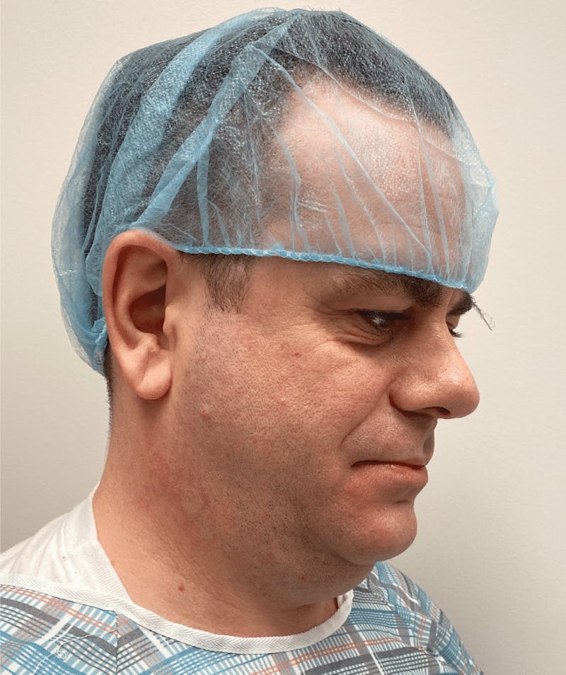 Neck Liposuction with Skin Tightening (Renuvion) Before & After Gallery - Patient 142622 - Image 3