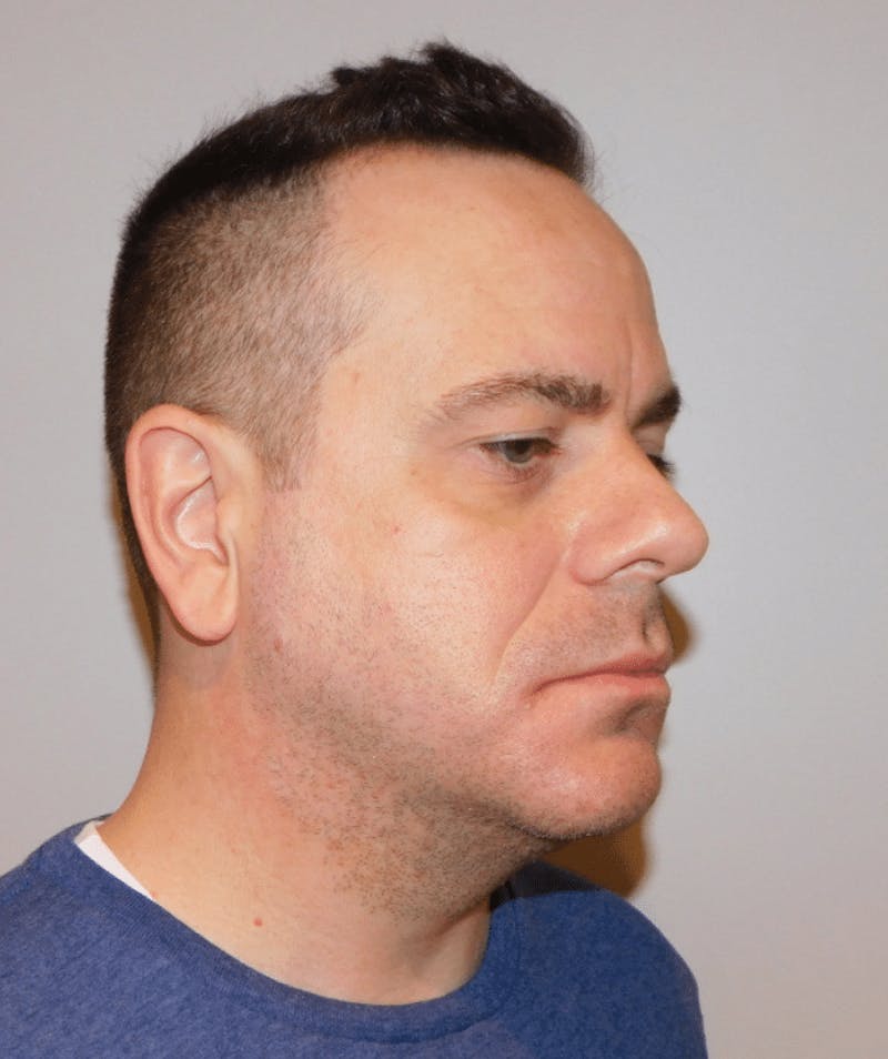 Neck Liposuction with Skin Tightening (Renuvion) Before & After Gallery - Patient 142622 - Image 4