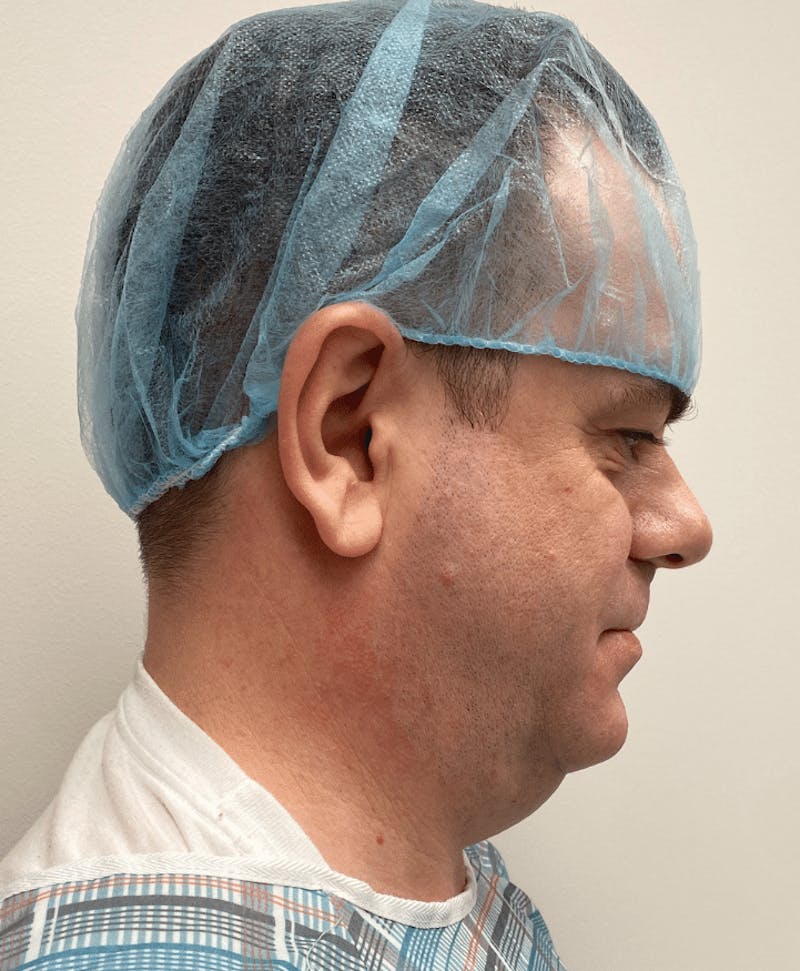 Neck Liposuction with Skin Tightening (Renuvion) Before & After Gallery - Patient 142622 - Image 5