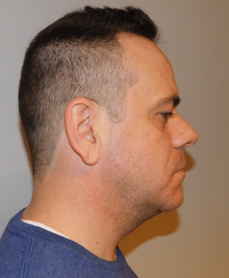 Neck Liposuction with Skin Tightening (Renuvion) Before & After Gallery - Patient 142622 - Image 6