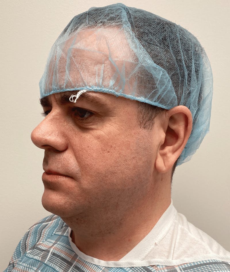 Neck Liposuction with Skin Tightening (Renuvion) Before & After Gallery - Patient 142622 - Image 7