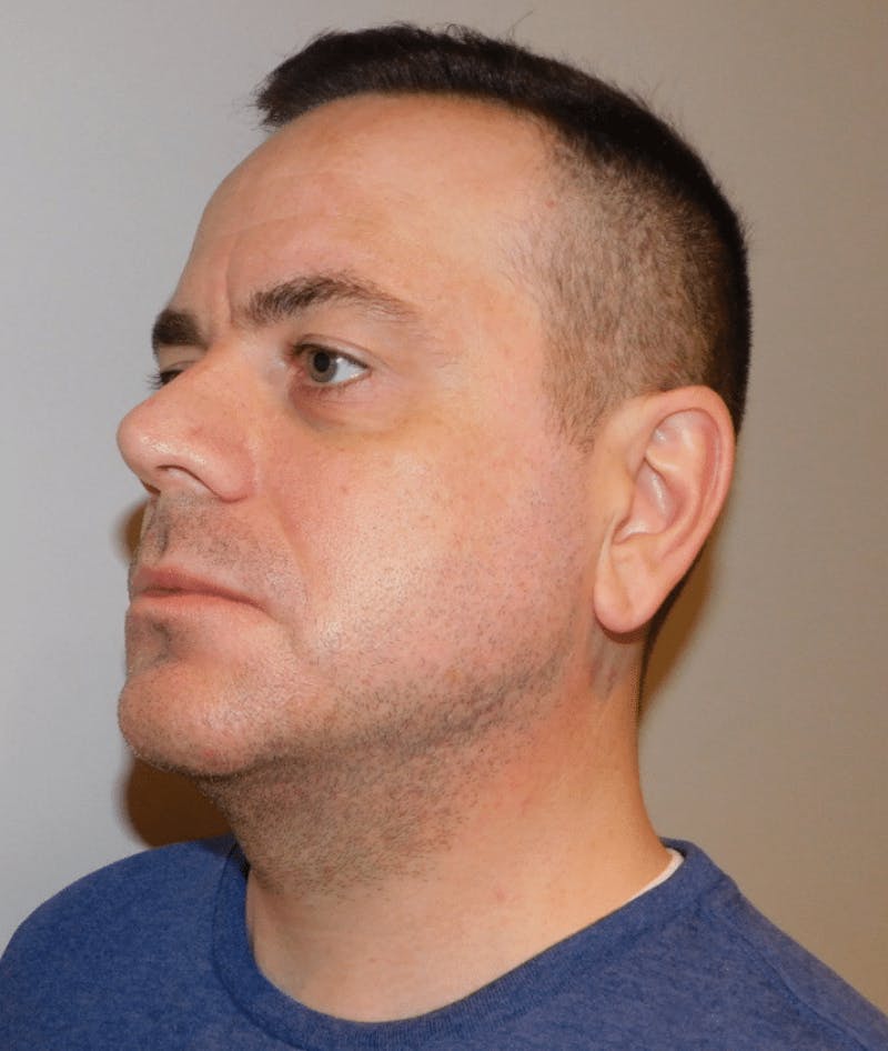 Neck Liposuction with Skin Tightening (Renuvion) Before & After Gallery - Patient 142622 - Image 8