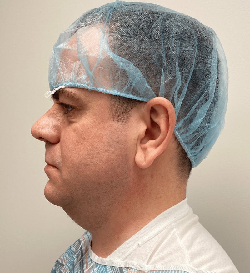 Neck Liposuction with Skin Tightening (Renuvion) Before & After Gallery - Patient 142622 - Image 9