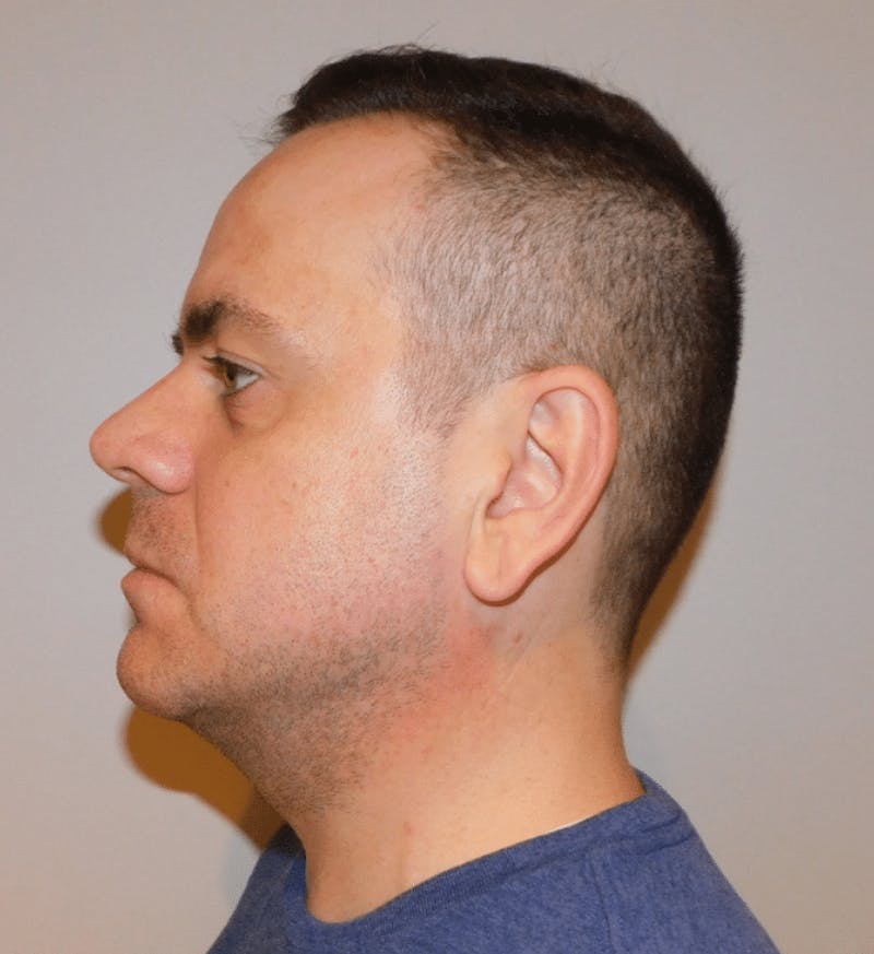 Neck Liposuction with Skin Tightening (Renuvion) Before & After Gallery - Patient 142622 - Image 10