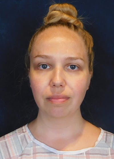 Neck Liposuction with Skin Tightening (Renuvion) Before & After Gallery - Patient 263204 - Image 1