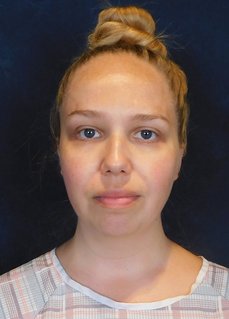 Neck Liposuction with Skin Tightening (Renuvion) Before & After Gallery - Patient 263204 - Image 1