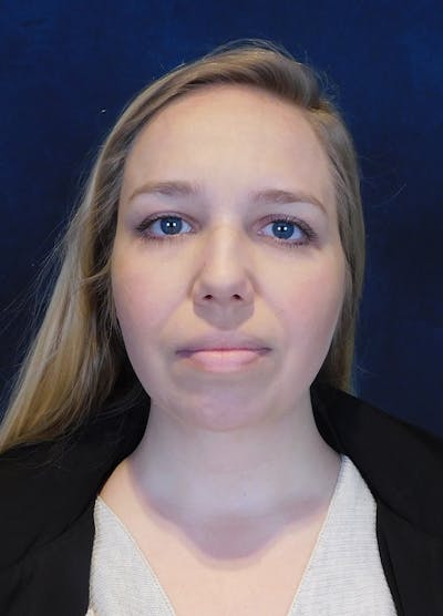 Neck Liposuction with Skin Tightening (Renuvion) Before & After Gallery - Patient 263204 - Image 2