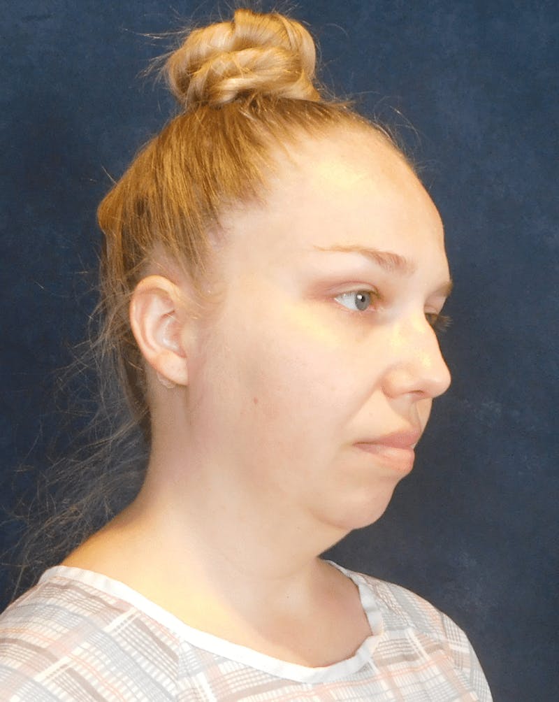 Neck Liposuction with Skin Tightening (Renuvion) Before & After Gallery - Patient 263204 - Image 3