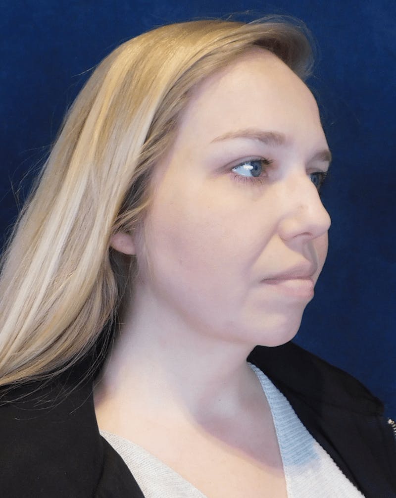 Neck Liposuction with Skin Tightening (Renuvion) Before & After Gallery - Patient 263204 - Image 4