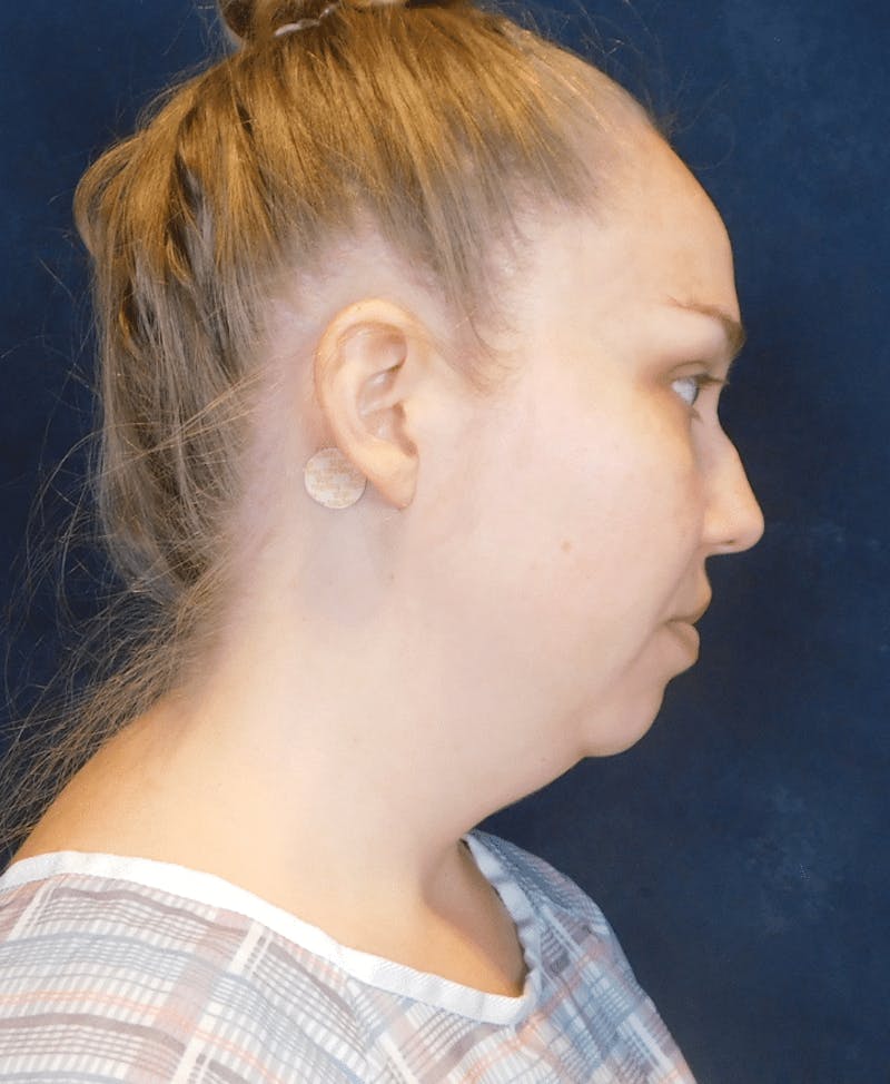 Neck Liposuction with Skin Tightening (Renuvion) Before & After Gallery - Patient 263204 - Image 5