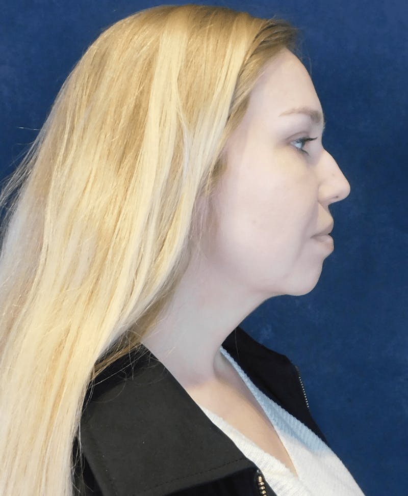 Neck Liposuction with Skin Tightening (Renuvion) Before & After Gallery - Patient 263204 - Image 6