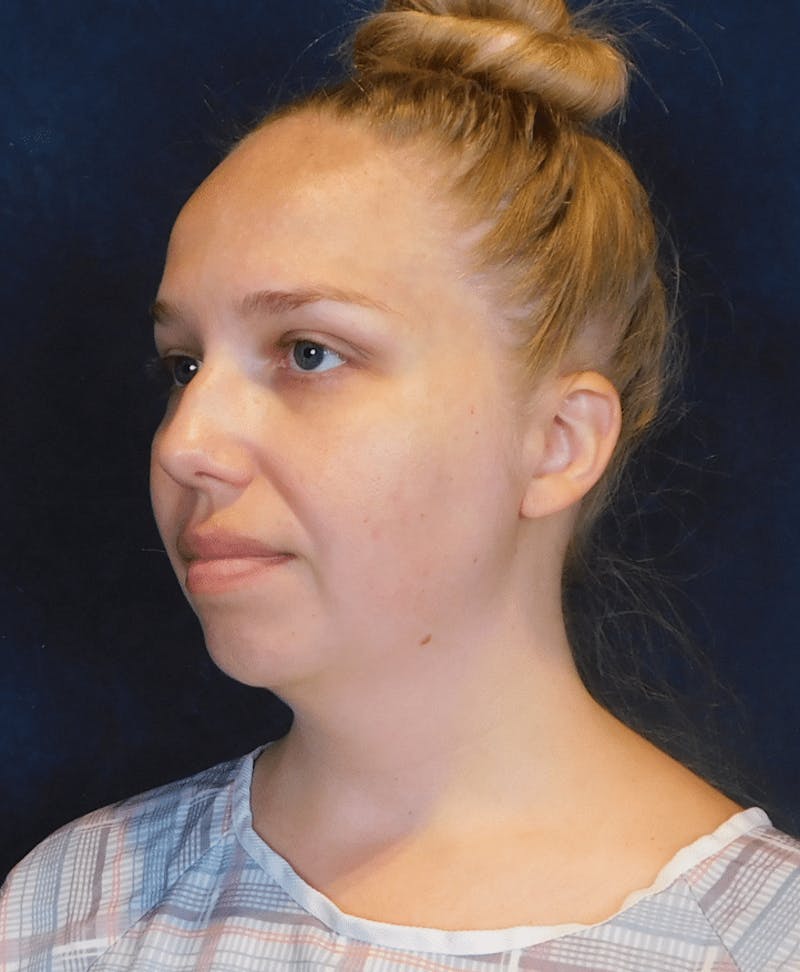 Neck Liposuction with Skin Tightening (Renuvion) Before & After Gallery - Patient 263204 - Image 7