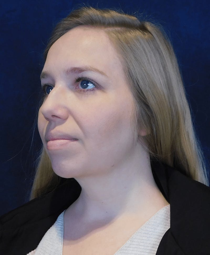 Neck Liposuction with Skin Tightening (Renuvion) Before & After Gallery - Patient 263204 - Image 8