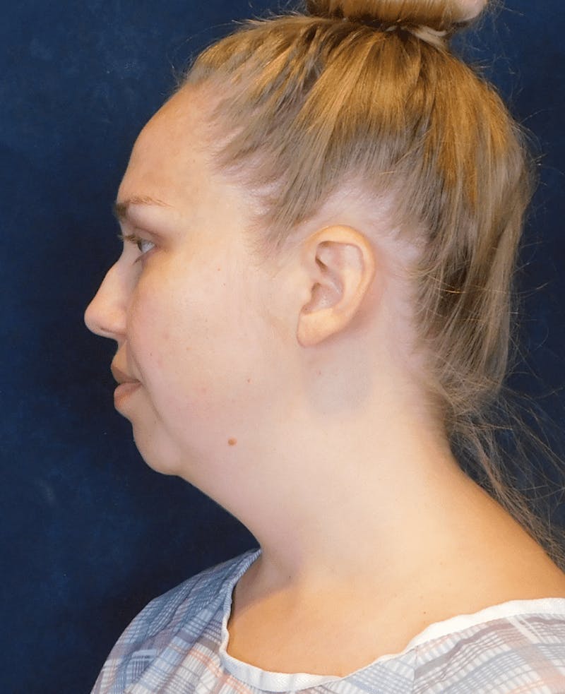 Neck Liposuction with Skin Tightening (Renuvion) Before & After Gallery - Patient 263204 - Image 9