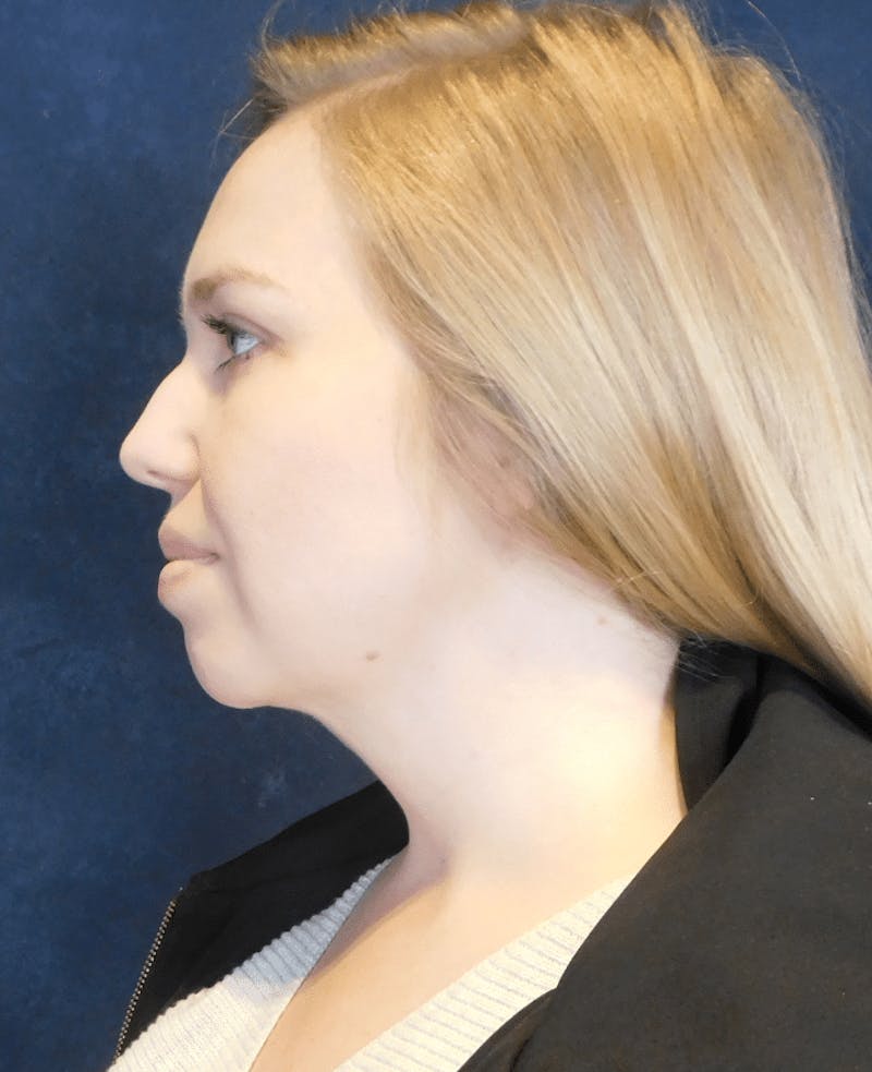 Neck Liposuction with Skin Tightening (Renuvion) Before & After Gallery - Patient 263204 - Image 10
