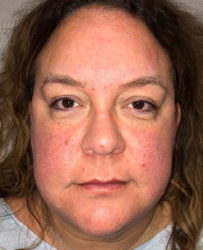 Blepharoplasty Before & After Gallery - Patient 240657 - Image 1
