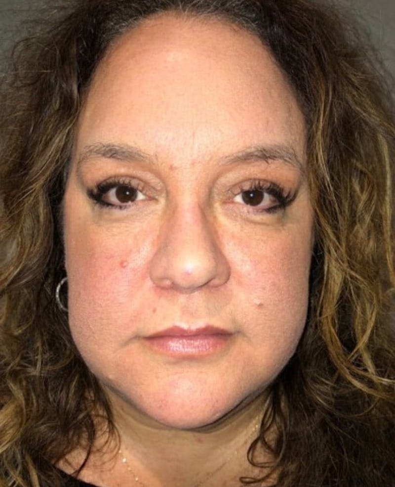 Blepharoplasty Before & After Gallery - Patient 240657 - Image 2