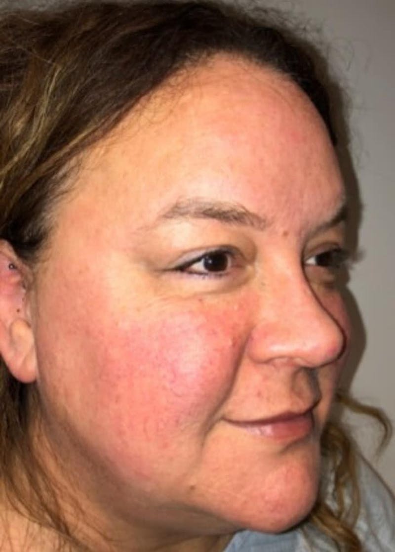 Blepharoplasty Before & After Gallery - Patient 240657 - Image 3