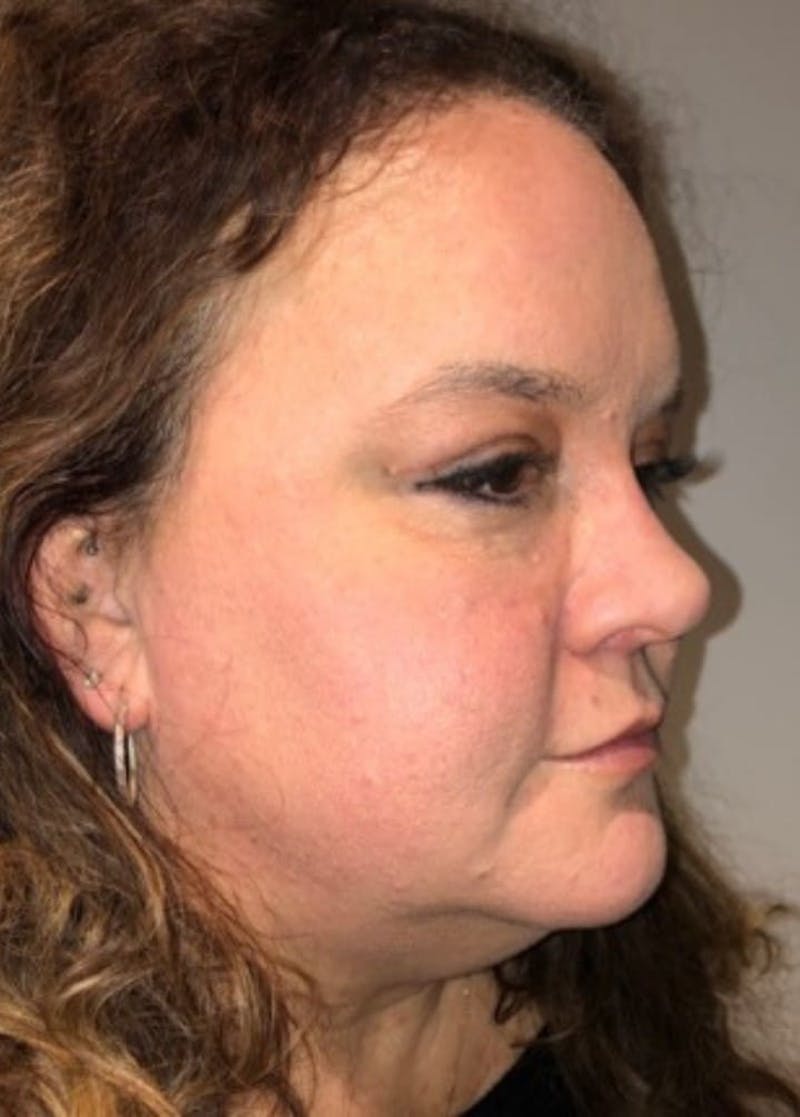 Blepharoplasty Before & After Gallery - Patient 240657 - Image 4