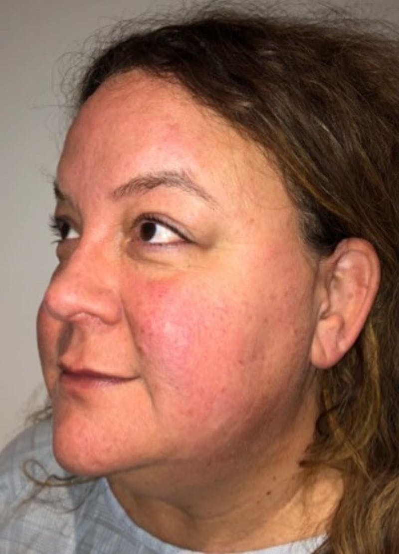 Blepharoplasty Before & After Gallery - Patient 240657 - Image 5