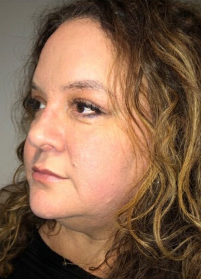 Blepharoplasty Before & After Gallery - Patient 240657 - Image 6