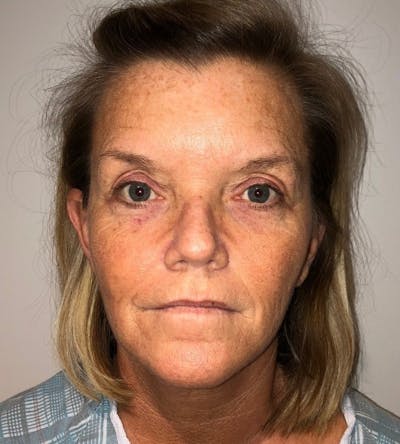 Blepharoplasty Before & After Gallery - Patient 341365 - Image 1