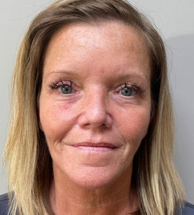 Blepharoplasty Before & After Gallery - Patient 341365 - Image 2