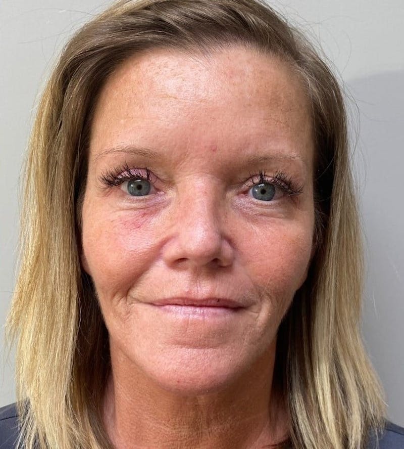 Blepharoplasty Before & After Gallery - Patient 341365 - Image 2