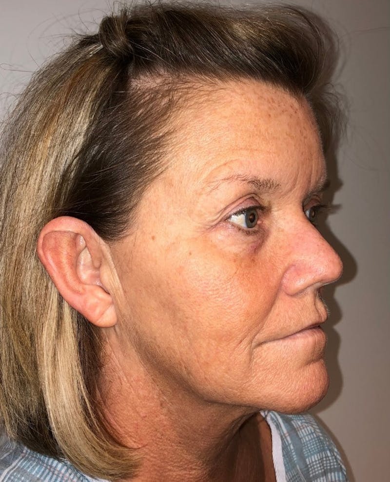 Blepharoplasty Before & After Gallery - Patient 341365 - Image 3