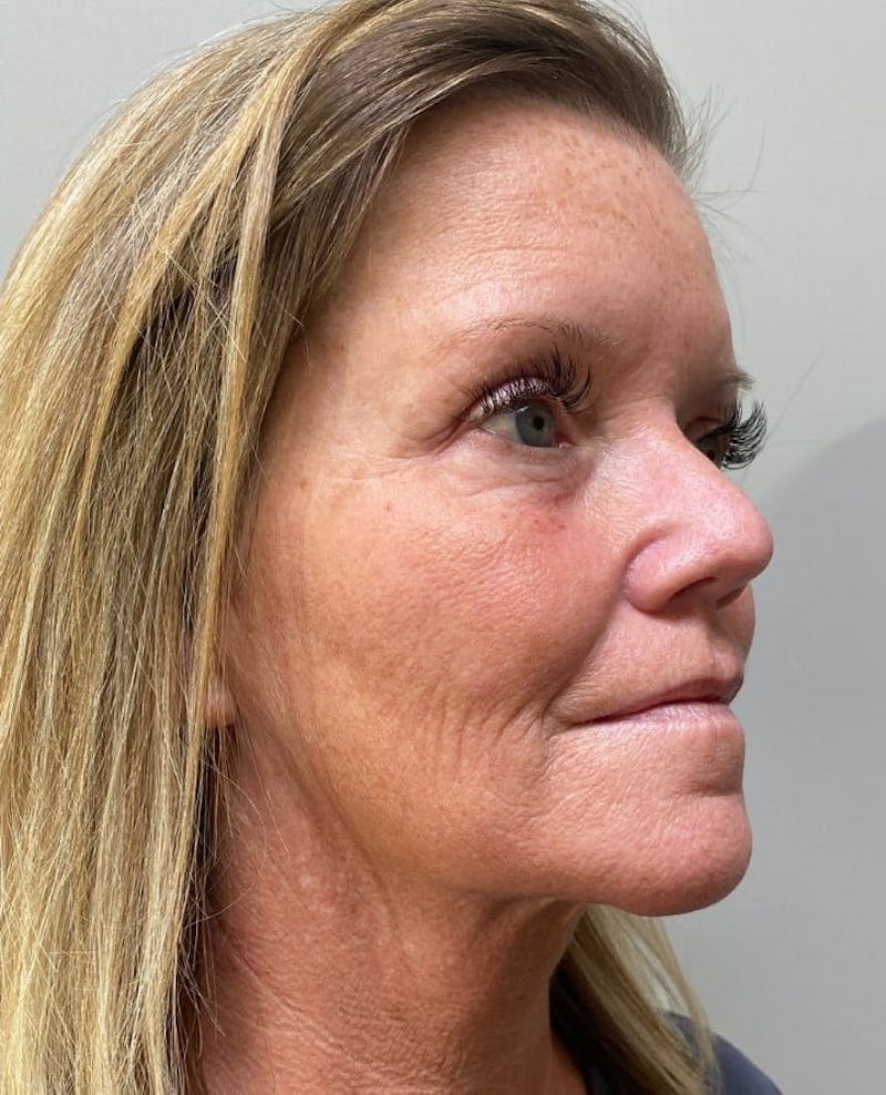 Blepharoplasty Before & After Gallery - Patient 341365 - Image 4