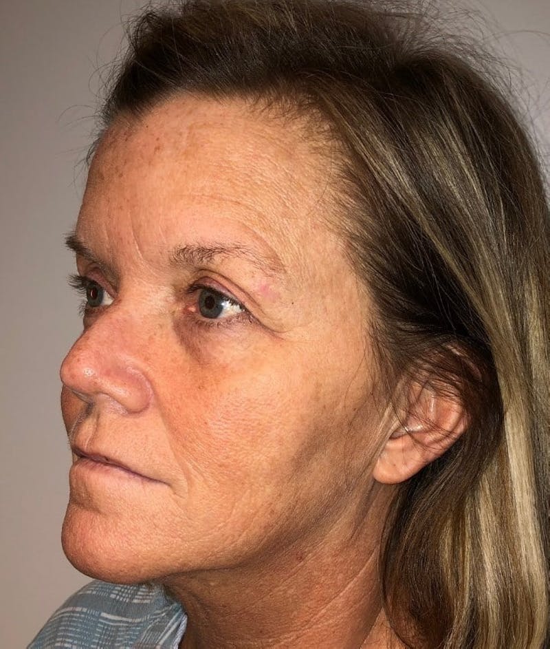 Blepharoplasty Before & After Gallery - Patient 341365 - Image 5