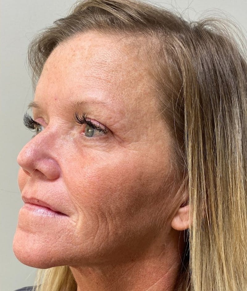 Blepharoplasty Before & After Gallery - Patient 341365 - Image 6