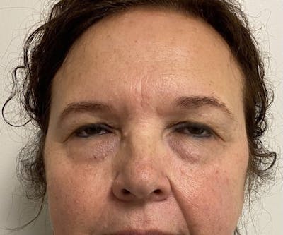 Blepharoplasty Before & After Gallery - Patient 559911 - Image 1