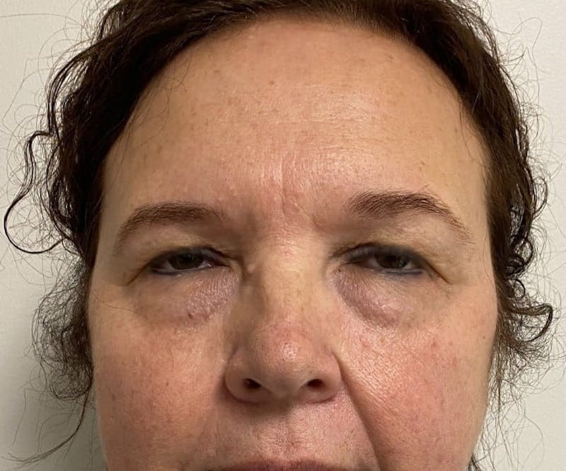 Blepharoplasty Before & After Gallery - Patient 559911 - Image 1