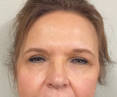 Blepharoplasty Before & After Gallery - Patient 559911 - Image 2