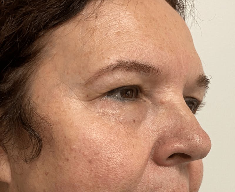 Blepharoplasty Before & After Gallery - Patient 559911 - Image 3
