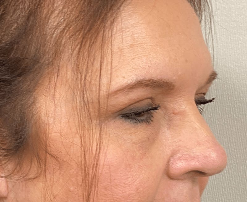 Blepharoplasty Before & After Gallery - Patient 559911 - Image 4