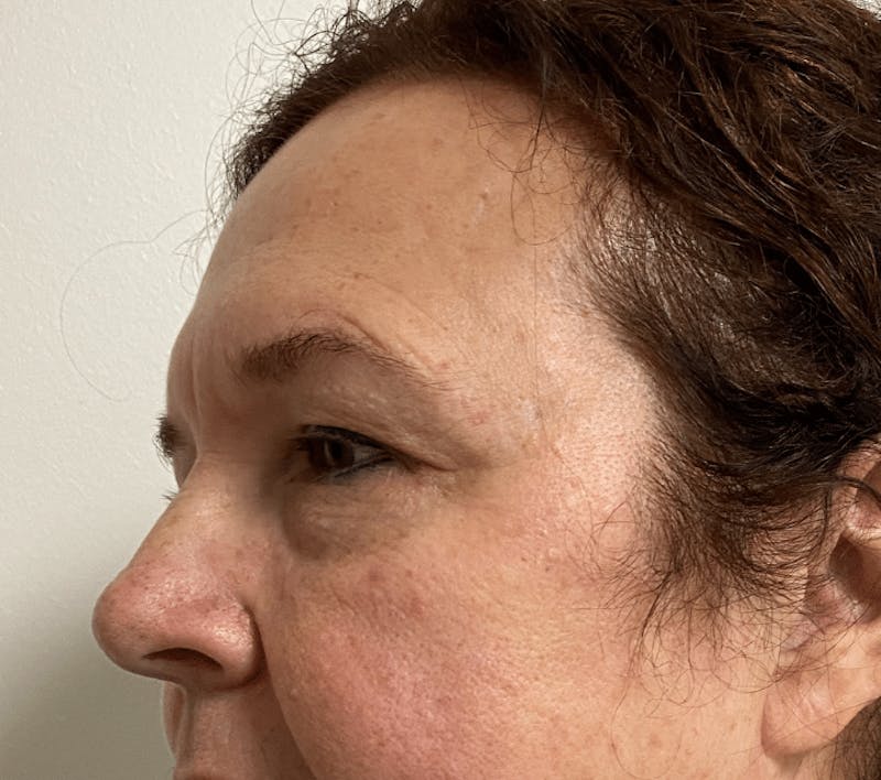 Blepharoplasty Before & After Gallery - Patient 559911 - Image 5