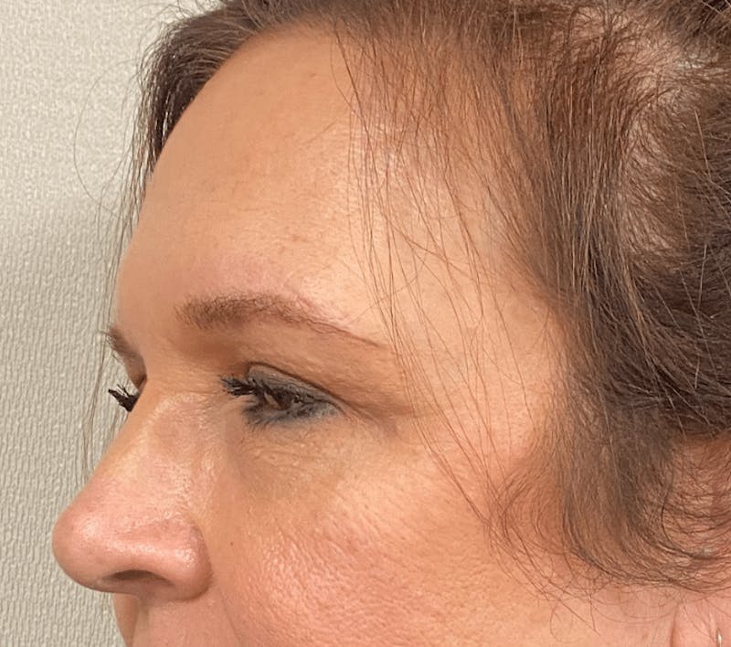 Blepharoplasty Before & After Gallery - Patient 559911 - Image 6