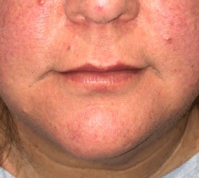 Surgical Lip Lift Before & After Gallery - Patient 591407 - Image 1
