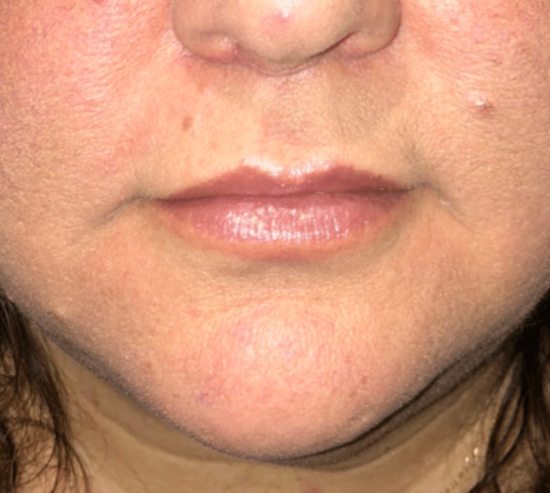 Surgical Lip Lift Before & After Gallery - Patient 591407 - Image 2