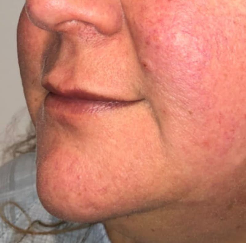 Surgical Lip Lift Before & After Gallery - Patient 591407 - Image 3