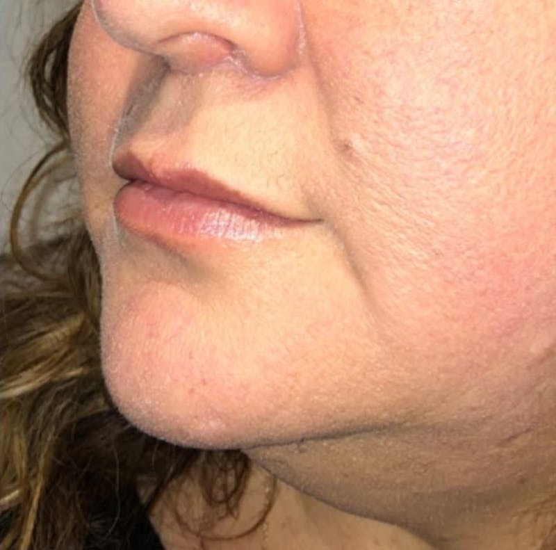 Surgical Lip Lift Before & After Gallery - Patient 591407 - Image 4