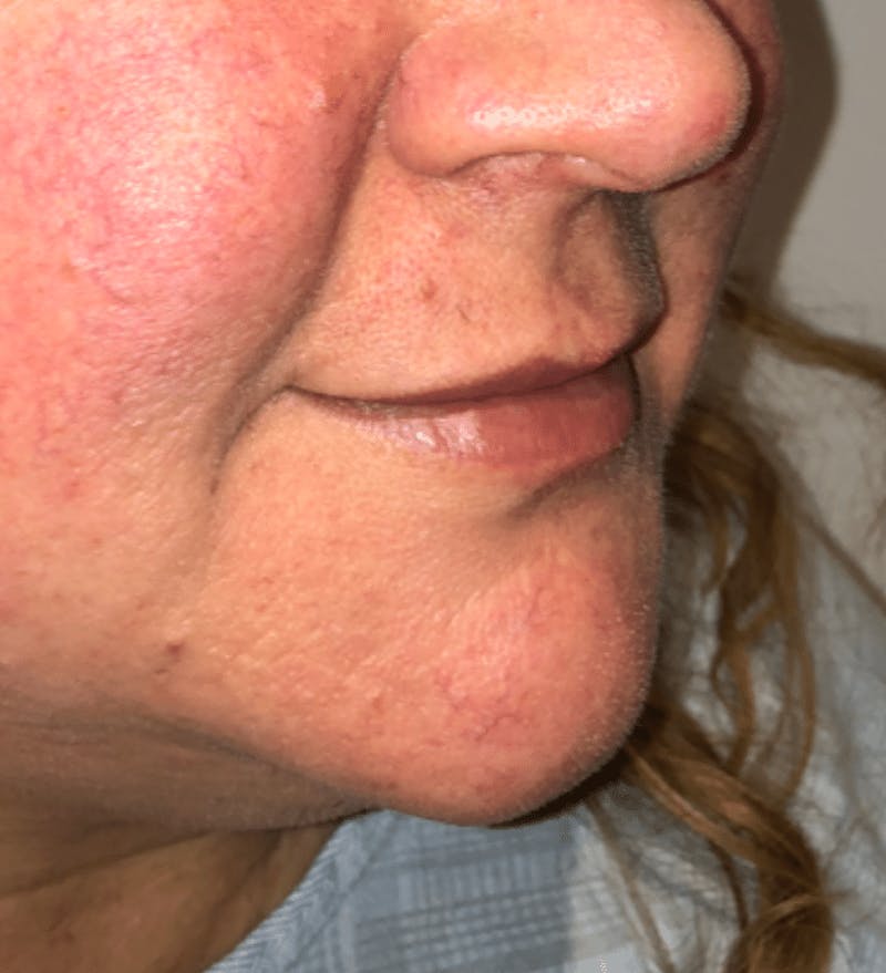 Surgical Lip Lift Before & After Gallery - Patient 591407 - Image 5