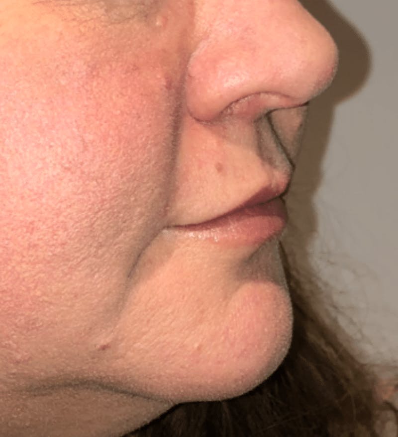 Surgical Lip Lift Before & After Gallery - Patient 591407 - Image 6